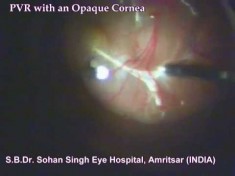 PVR Opaque Cornea